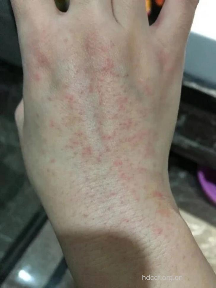 皮肤过敏竟是洗衣机惹的祸