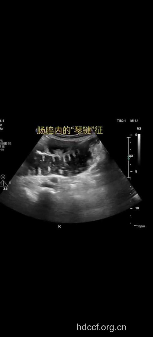 肠梗阻的检查特征有哪些