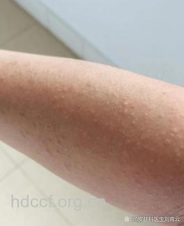 注意:防晒值过高易致皮肤过敏