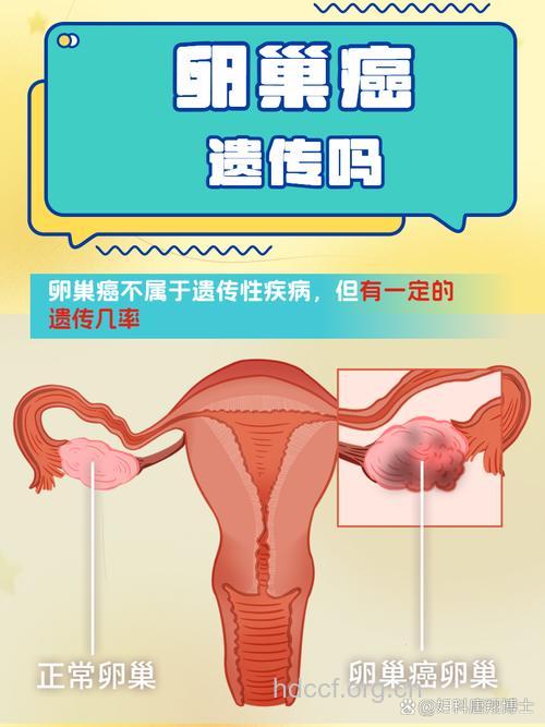 卵巢癌可能会遗传吗