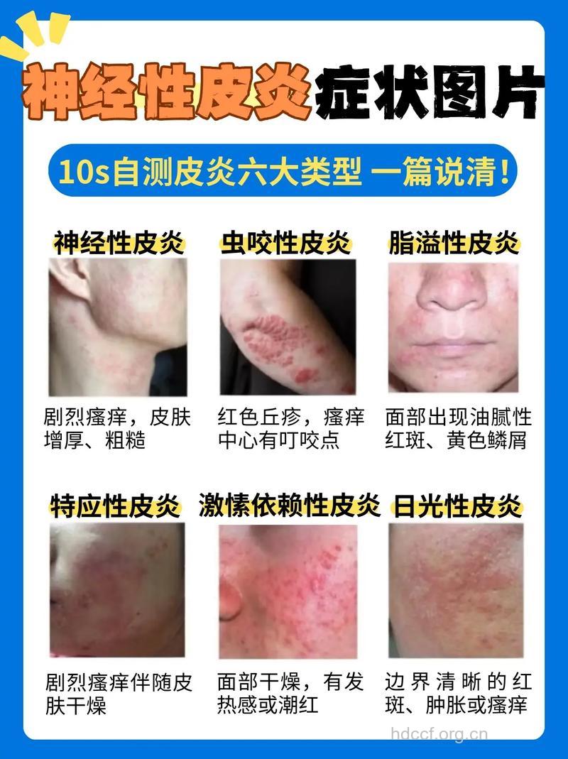 时刻提防神经性皮炎恶化