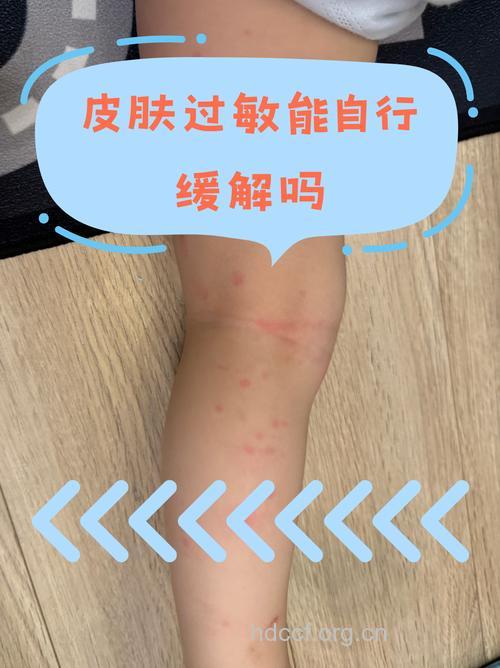 做到这10点 过敏不敢再犯