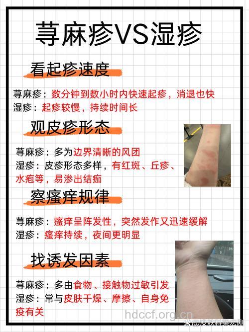 为什么夏季会皮肤过敏