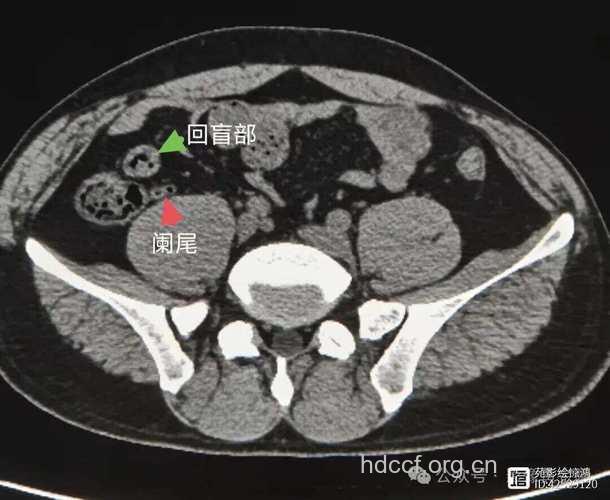 CT检查阑尾炎好吗