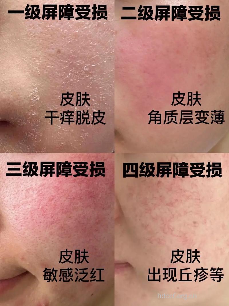 显示器为什么会导致肌肤过敏