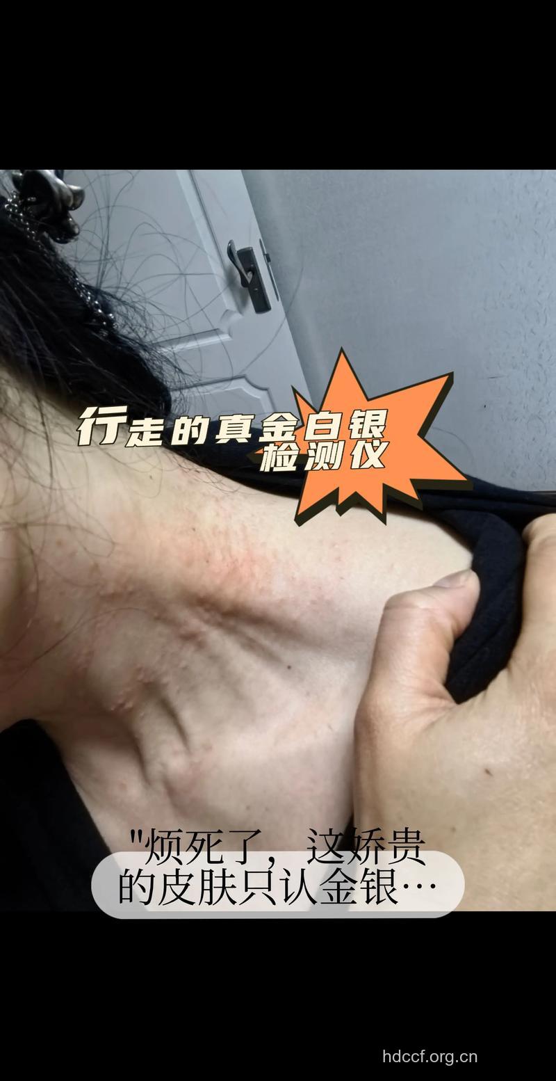 怎么戴首饰会导致皮肤过敏