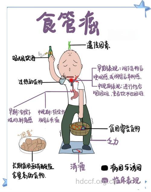 食道癌的病因及预防方法
