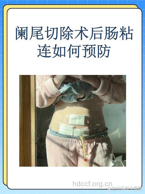 年青人做预防性阑尾切除术有必要吗