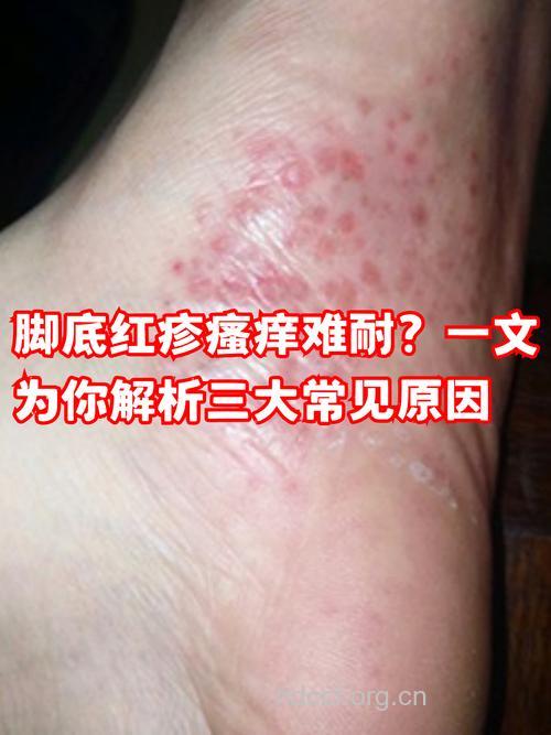 日常生活中哪些原因导致脚过敏