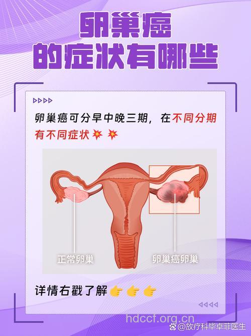 卵巢癌典型症状有哪些呢
