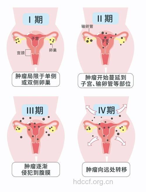 卵巢癌的病因与什么有关