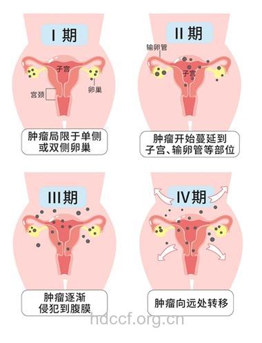 内分泌紊乱是卵巢癌的病因之一