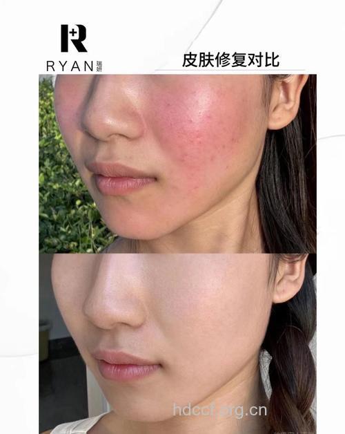 小议皮肤过敏的保养和修复