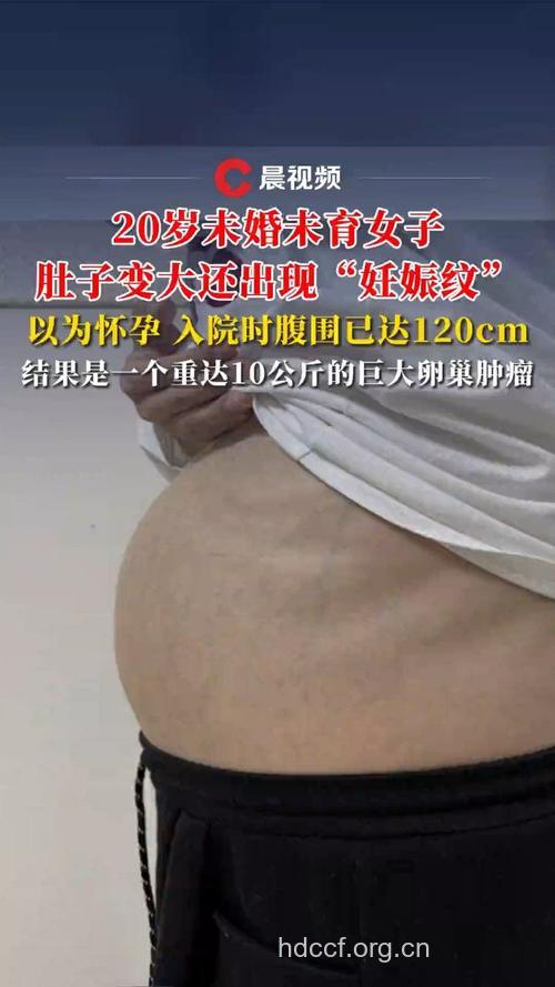 少女时期肥胖易患卵巢癌