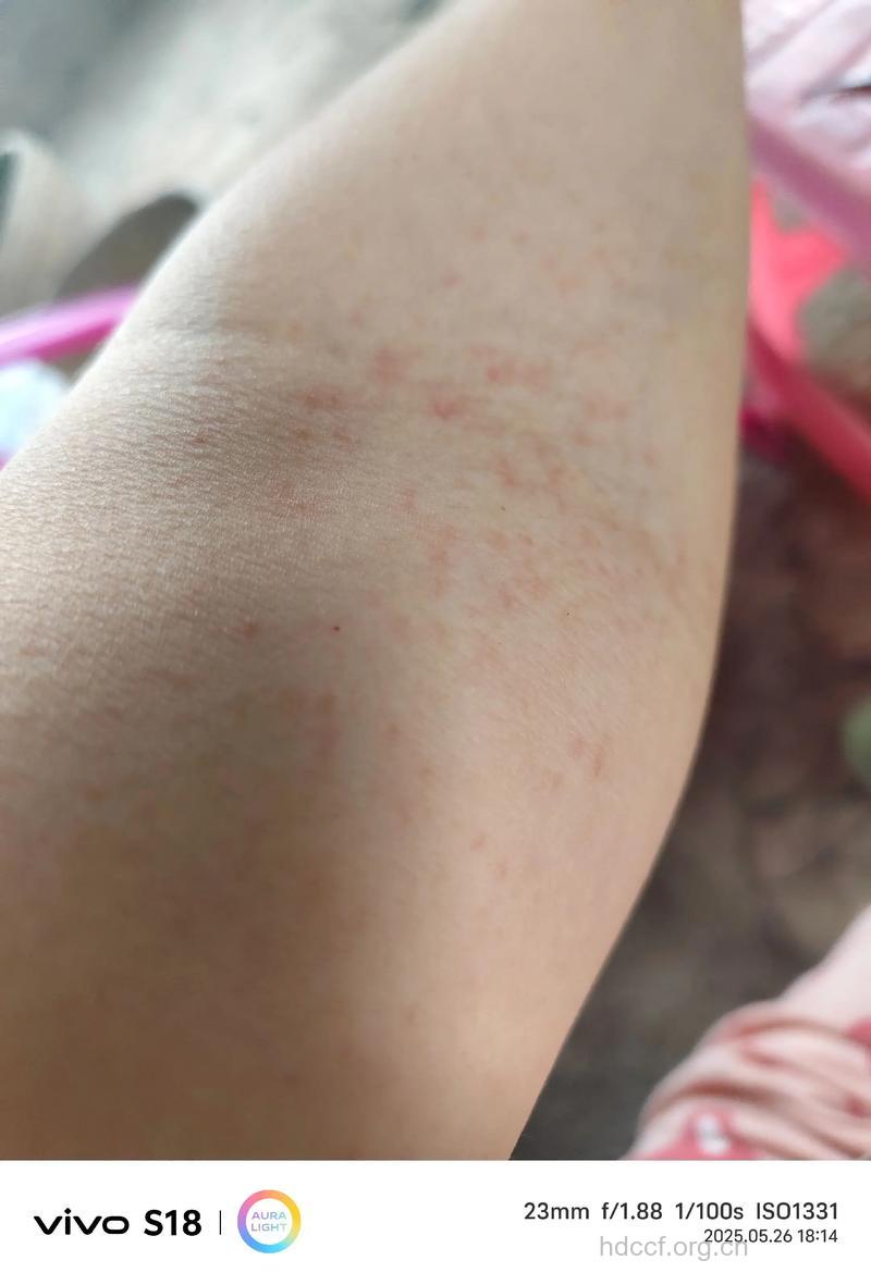 吃荔枝过多易发过敏性皮炎