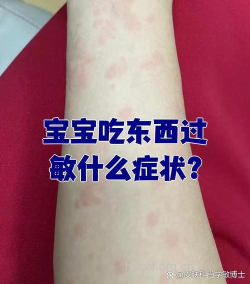 孩子爱吃零食小心患上过敏性紫癜