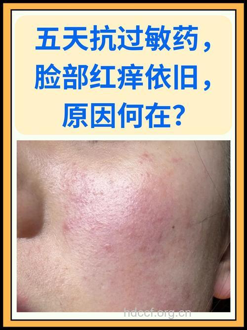 脸部皮肤过敏乱涂药膏小心变成激素脸