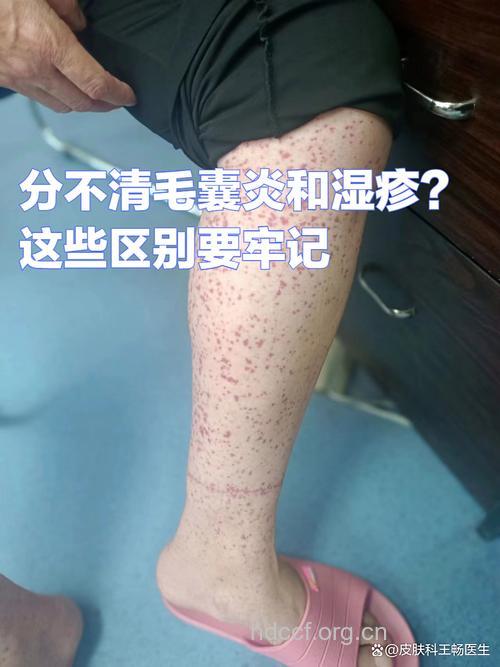 傻傻分不清楚？湿疹和毛囊炎的区别