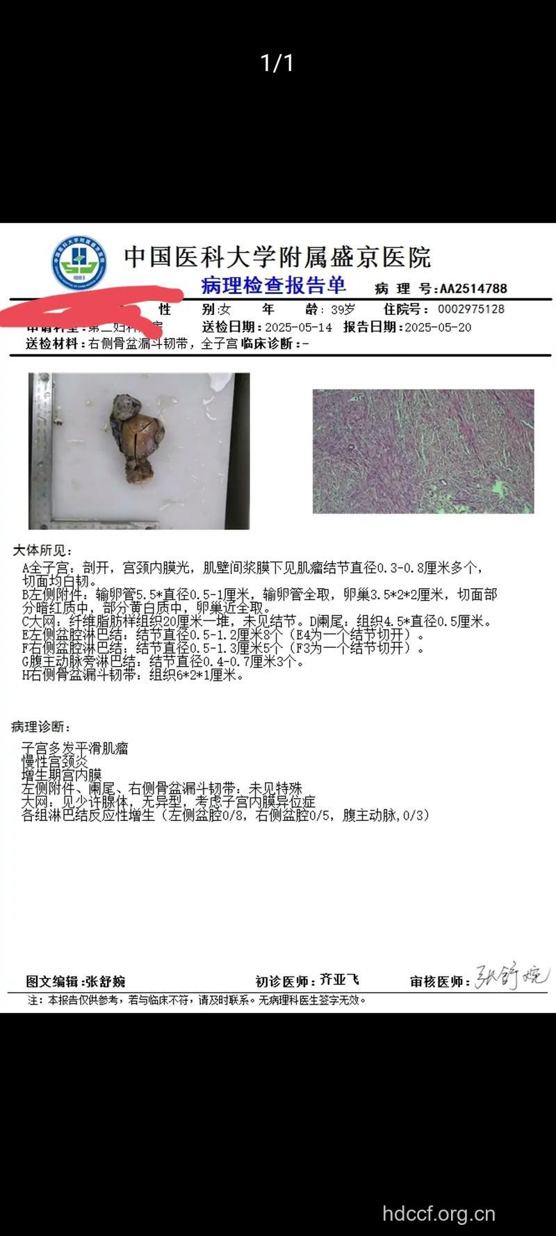 诊断鉴别卵巢恶性肿瘤
