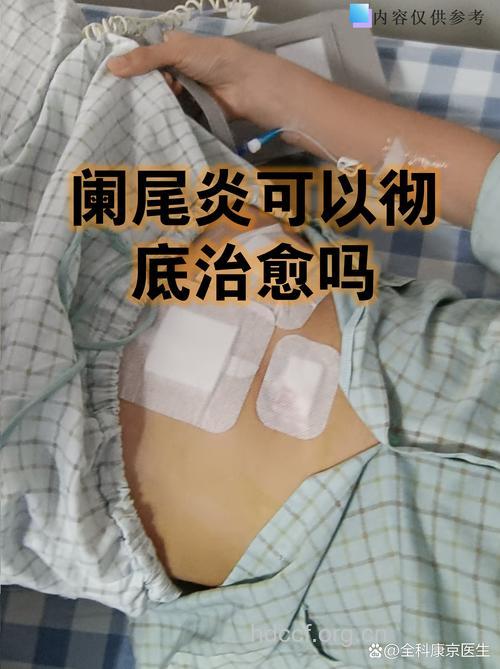 阑尾炎患者可以完全痊愈吗？