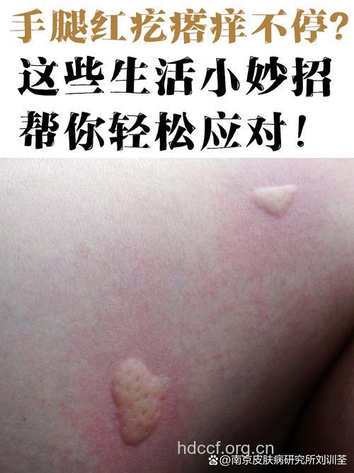 使用电热毯可致接触性皮炎
