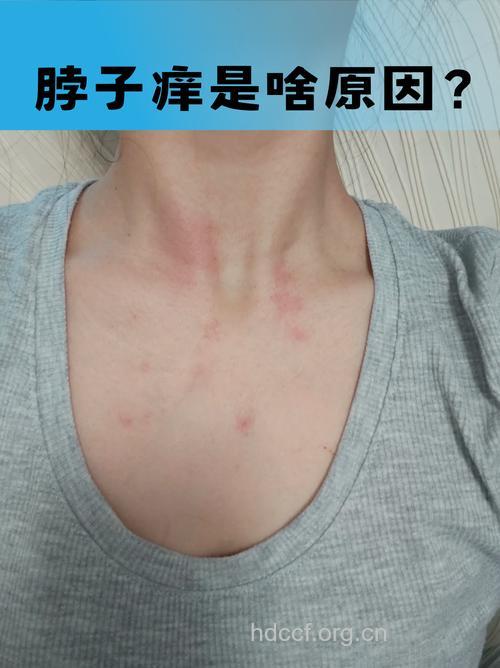 夏季吹空调小心过敏 夏季过敏原有哪些