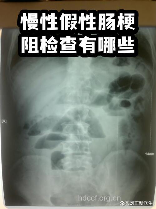 慢性的假性的肠梗阻