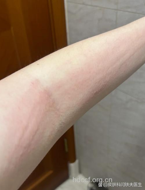 将羊毛衫干洗也会引起皮肤过敏