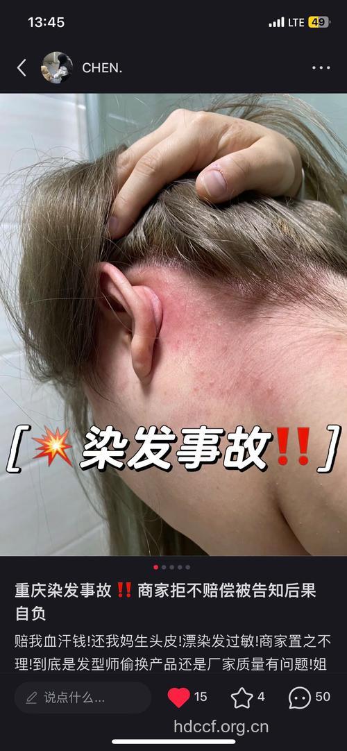 女子连续染发过敏进医院