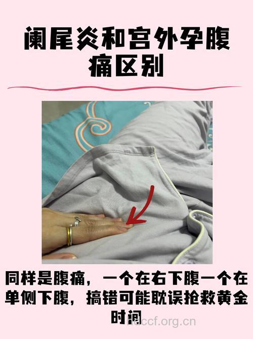 辨别宫外孕的急性阑尾炎