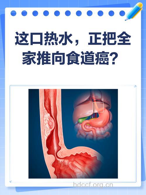 长期大量饮酒易会引发食道癌