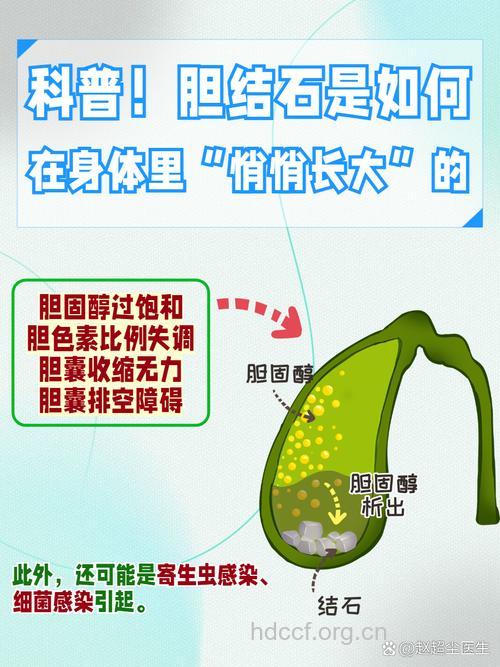 胆结石引起肠梗阻的原因