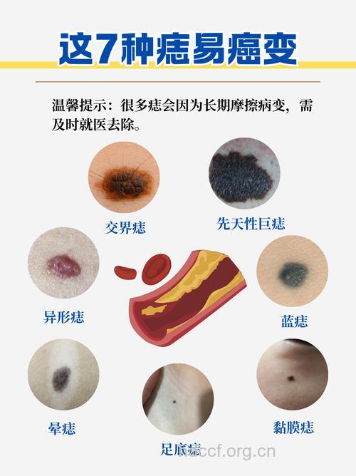 早期皮肤癌有哪些征兆