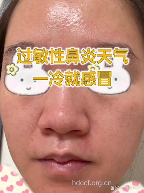 冬季寒风习习 过敏性鼻炎多发