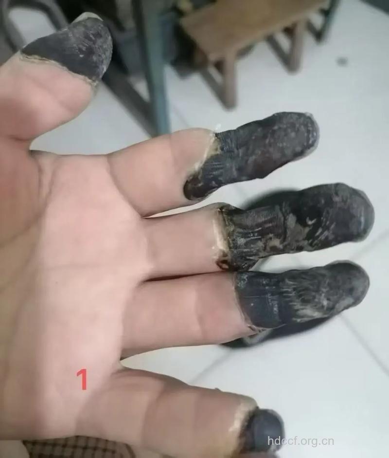 急性阑尾炎幕后的黑手