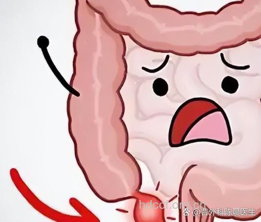 精神刺激引发“阑尾炎”