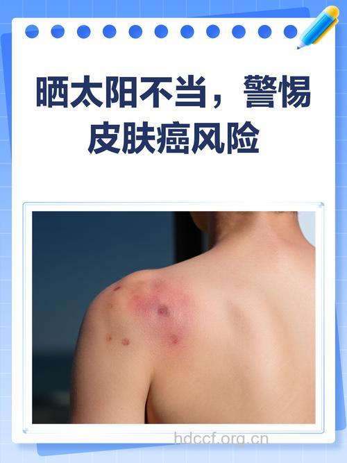 警惕!洗澡太频繁或致皮肤癌
