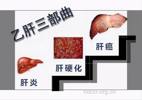 乙肝治疗的“四大软肋”!