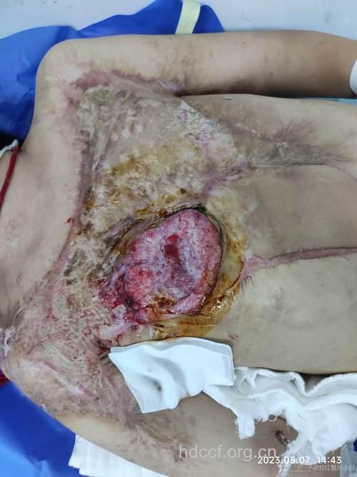 皮肤癌晚期如何扩散转移