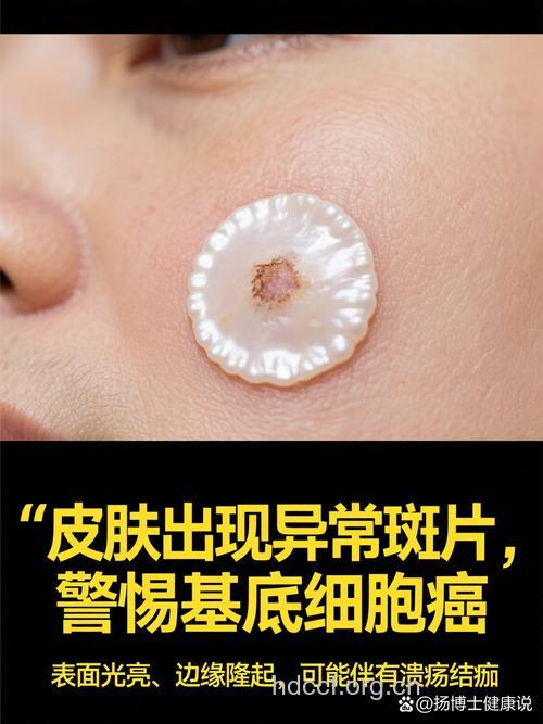 驾车开窗容易患上皮肤癌