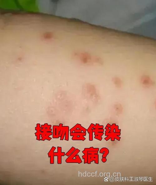 接吻可能传播皮肤癌病毒