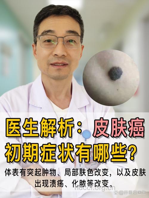 皮肤癌的简单介绍