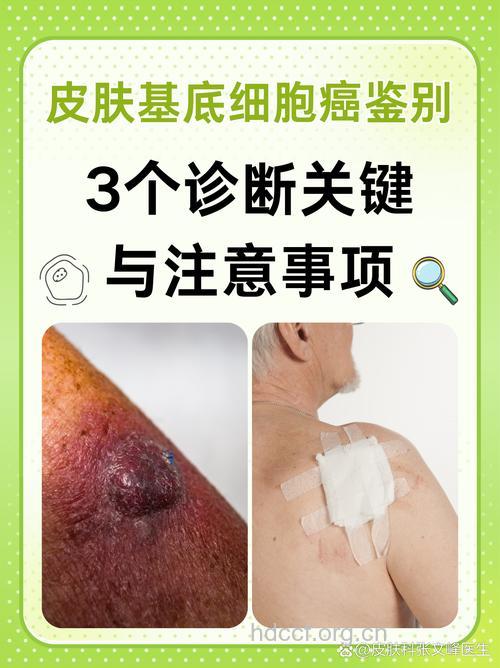 肾移植患者需定期检测皮肤癌