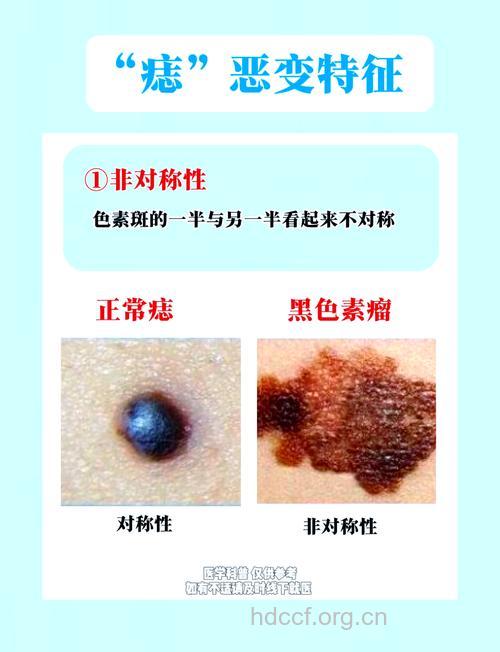 警惕:九种极易癌变的色素痣