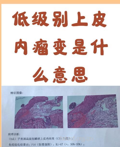 罕见皮肤癌可不治自愈