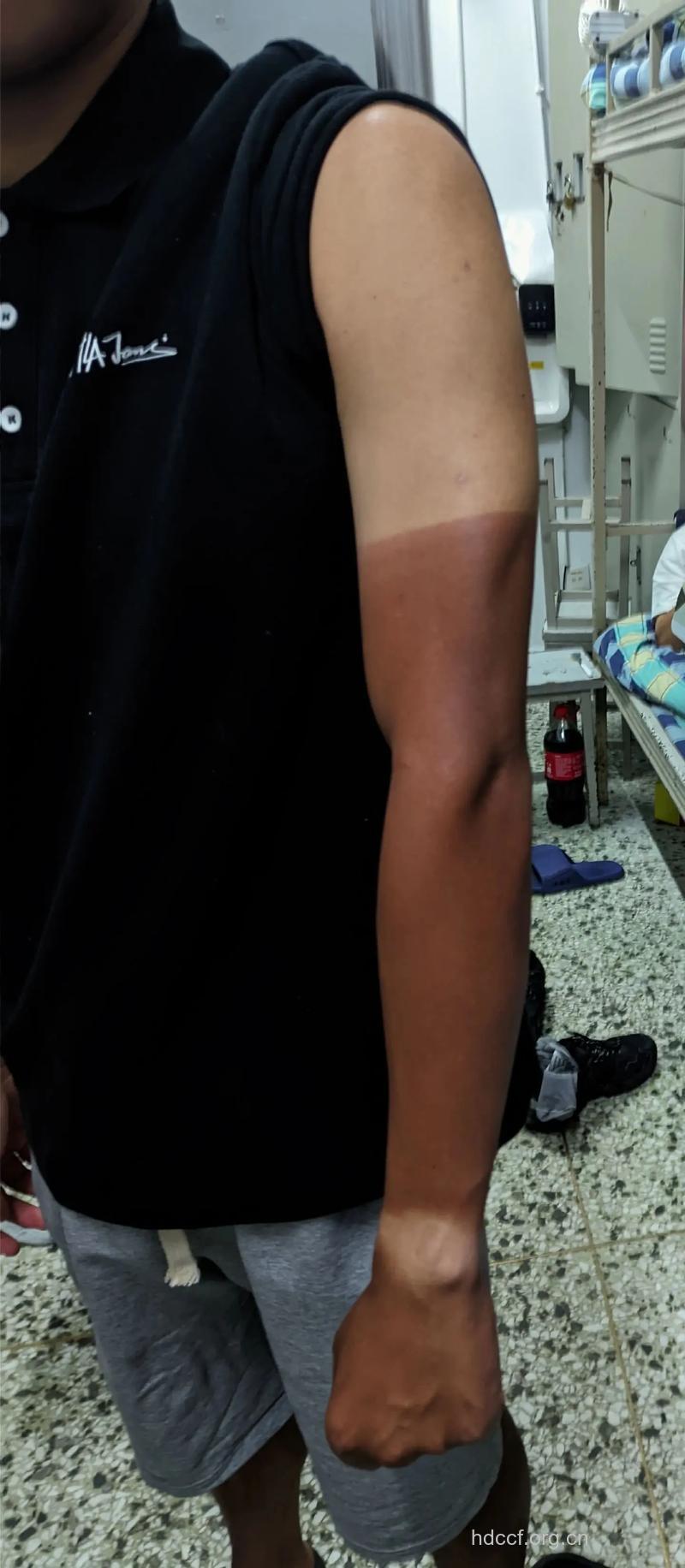 晒黑容易诱发皮肤癌