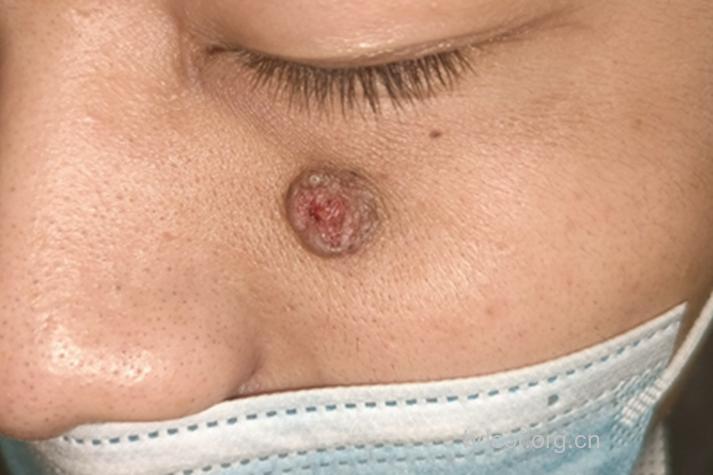 溃疡久治不愈易患皮肤癌