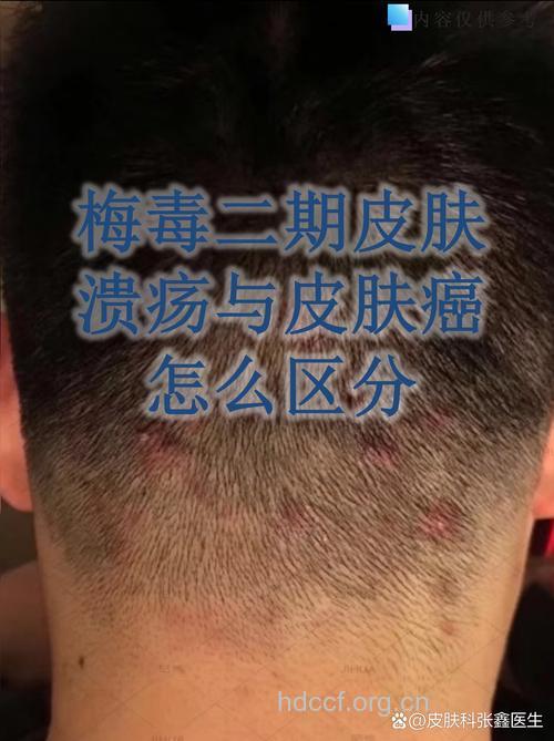皮肤癌容易和什么疾病混淆