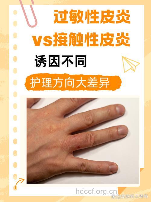 过敏性皮炎与接触性皮炎的区别