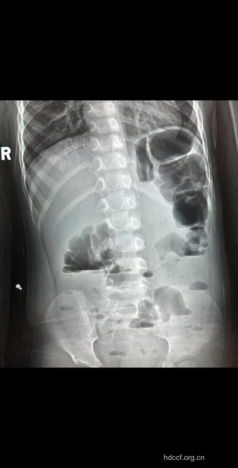 单纯性肠梗阻的影像学表现